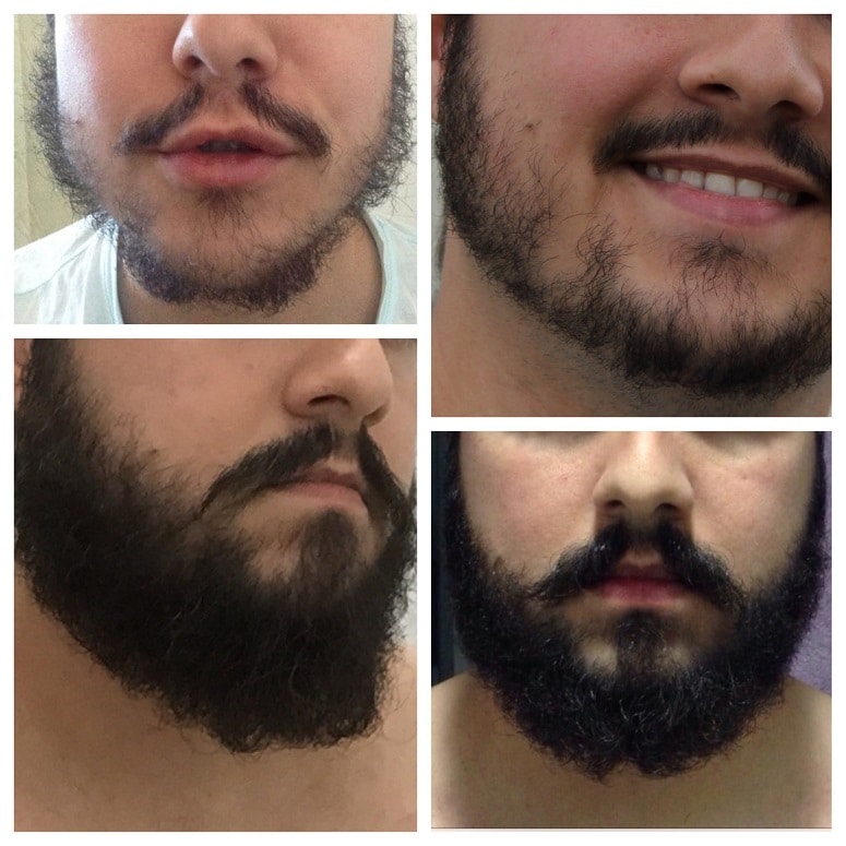 Minoxidil barba antes e depois do uso